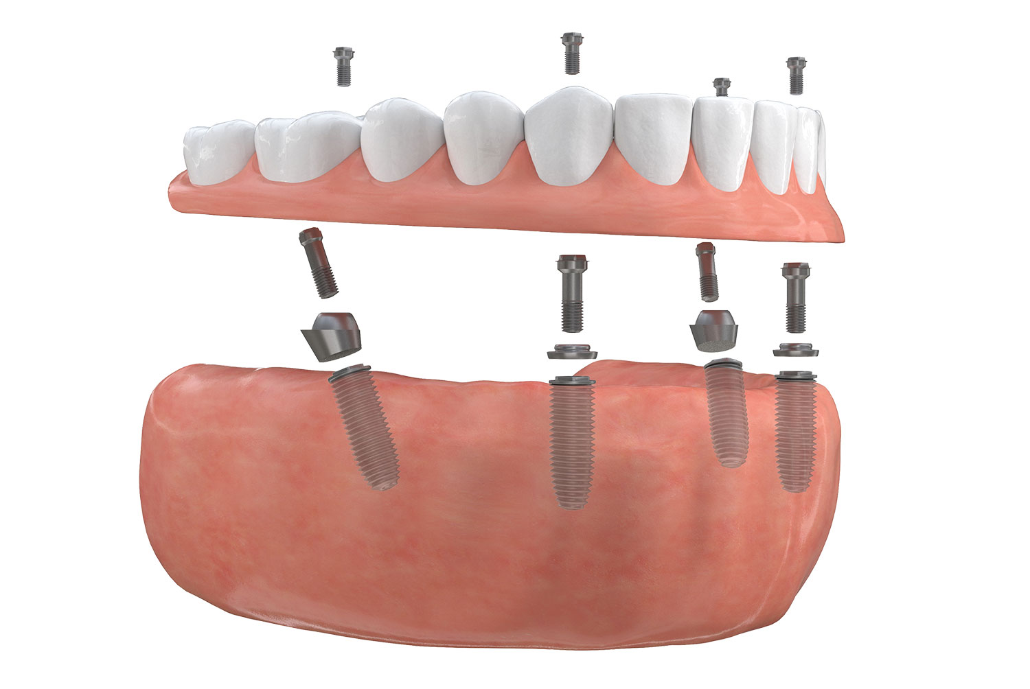 All-on-4 Full Mouth